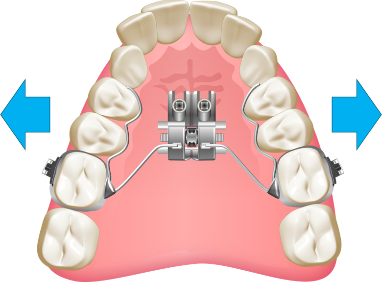 Vista oclusal do expansor Hybrid Hyrax ancorado em mini-implantes palatinos, com setas indicando a expansão.