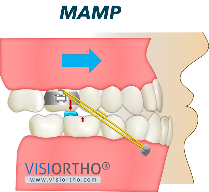 Ilustração do Visiortho do protocolo MAMP.