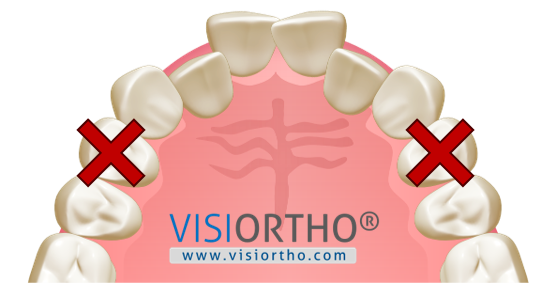 Arcada superior com indicação de não extração dos dentes posteriores.