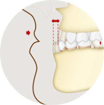 Ilustração da relação maxilomandibular em Classe III esquelética por deficiência de maxila.