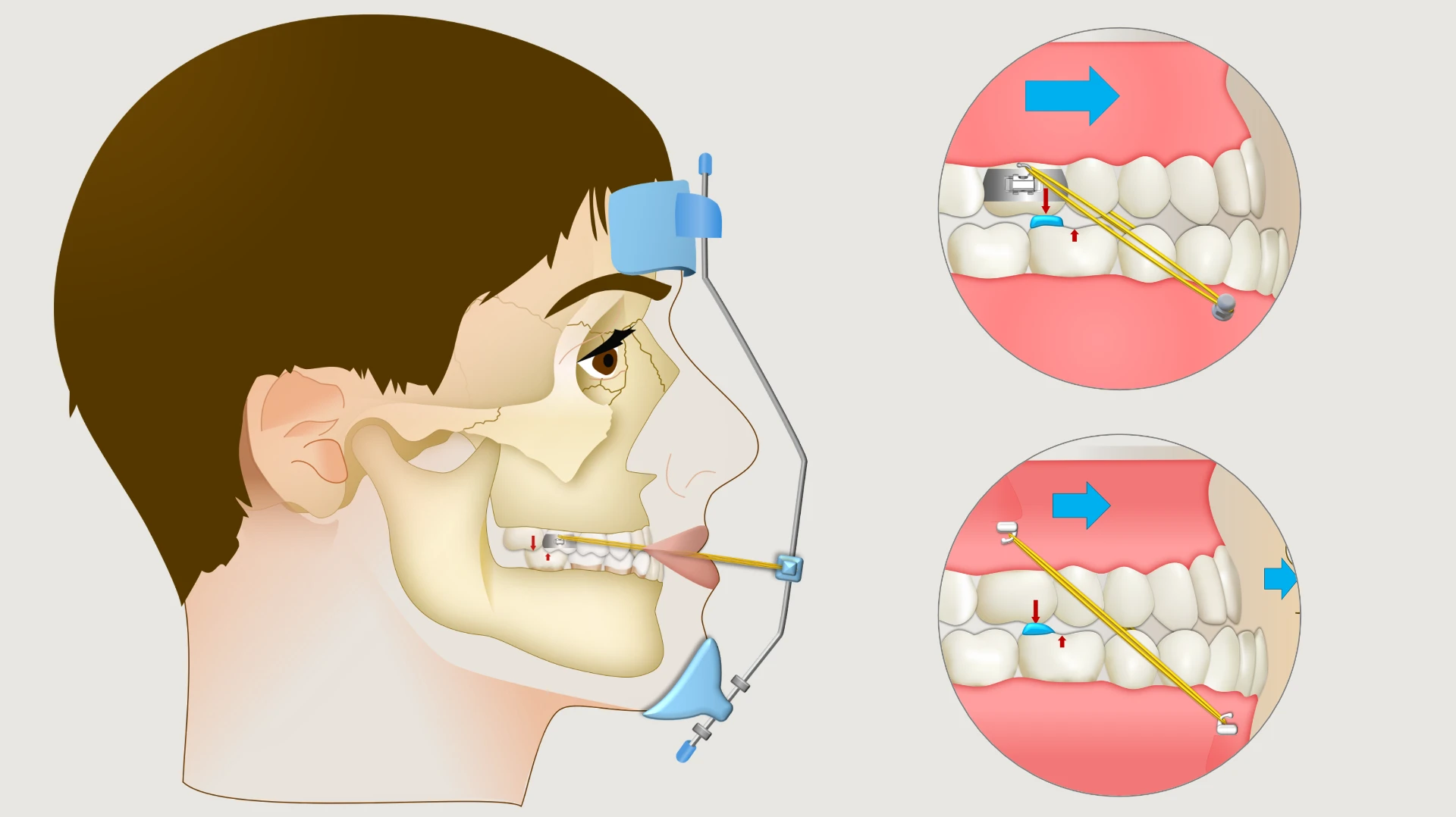 Ilustração de tratamento ortodôntico com máscara facial e elásticos