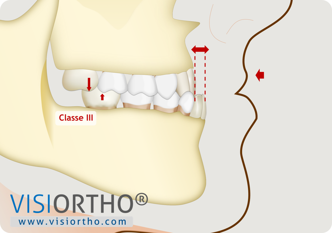 Ilustração do Visiortho mostrando relação de Classe III antes do tratamento.