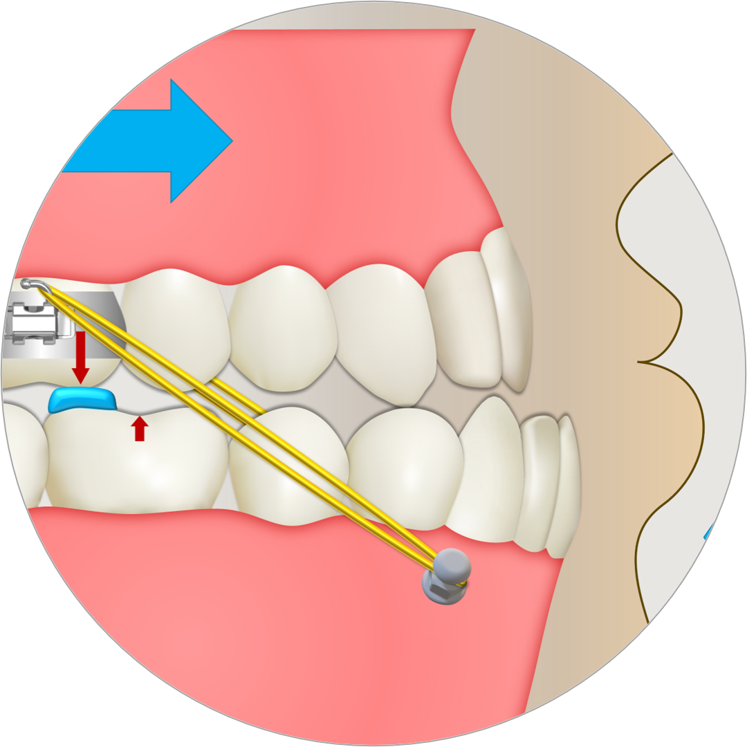 Detalhe dos elásticos de Classe III conectando o expansor maxilar aos mini-implantes mandibulares.