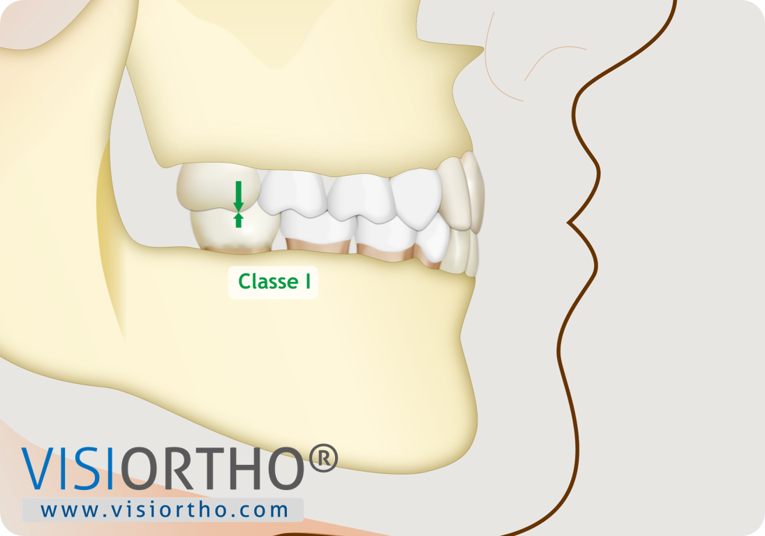 Ilustração do Visiortho mostrando relação de Classe I após o tratamento.