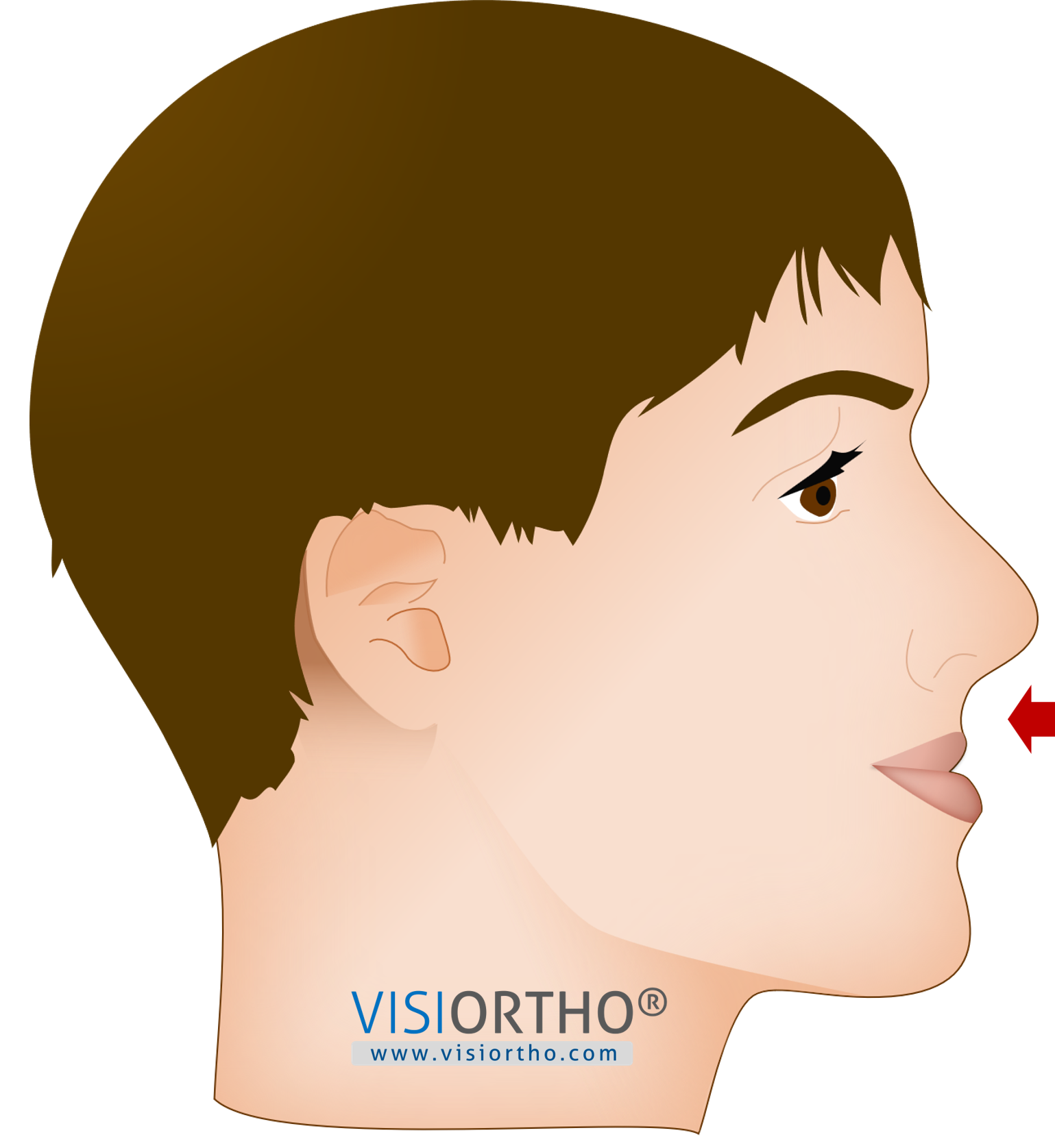 Perfil facial de paciente com má oclusão de Classe III e deficiência maxilar.