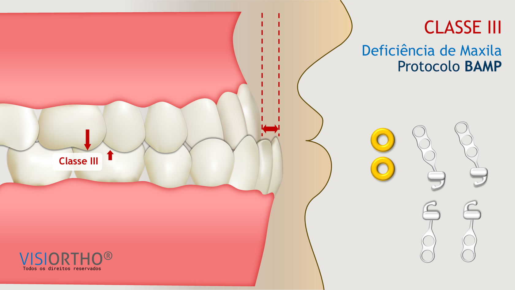 Ilustração do Visiortho mostrando criança com máscara facial no tratamento de Classe III.