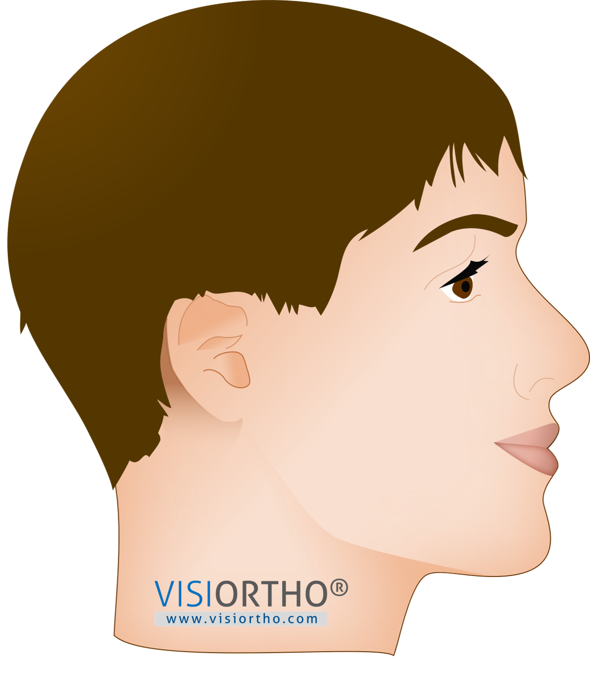 Perfil facial harmonizado após o avanço maxilar promovido pelo protocolo MAMP.