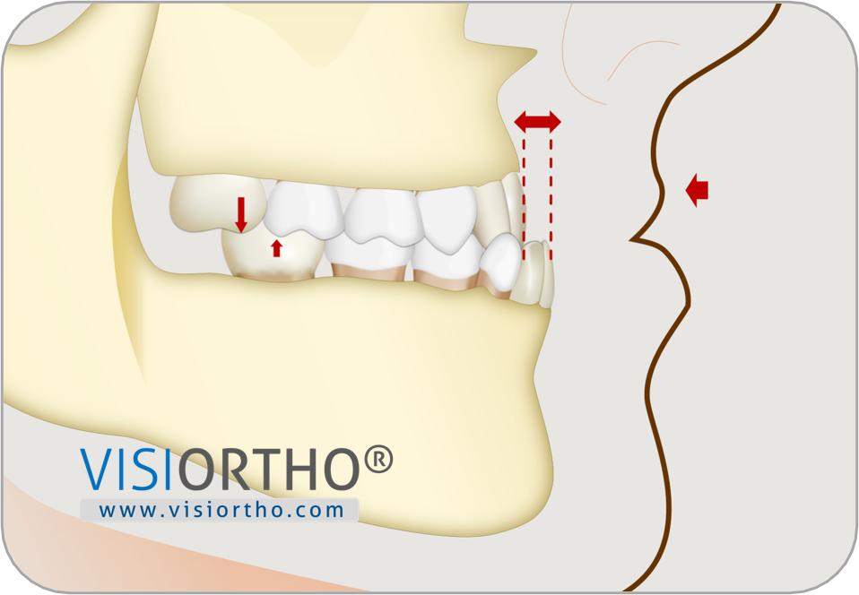 Ilustração do Visiortho mostrando mordida cruzada anterior e deficiência maxilar.