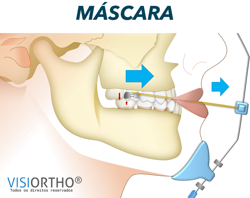 Ilustração do Visiortho do protocolo com máscara facial.
