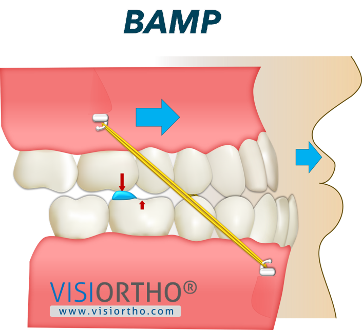 Ilustração do Visiortho do protocolo BAMP.