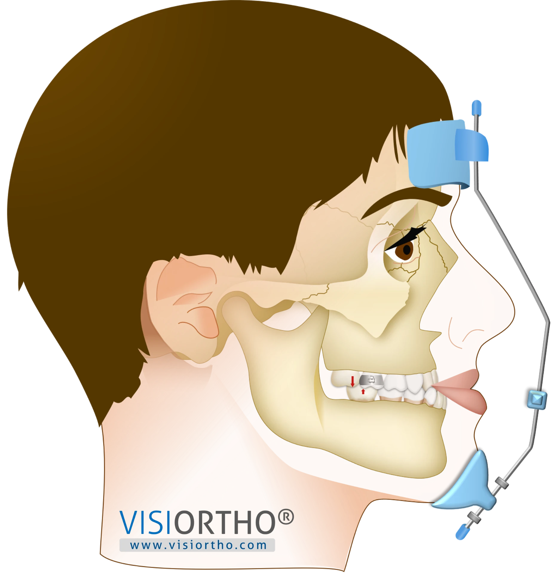 Paciente utilizando máscara facial para protração maxilar.