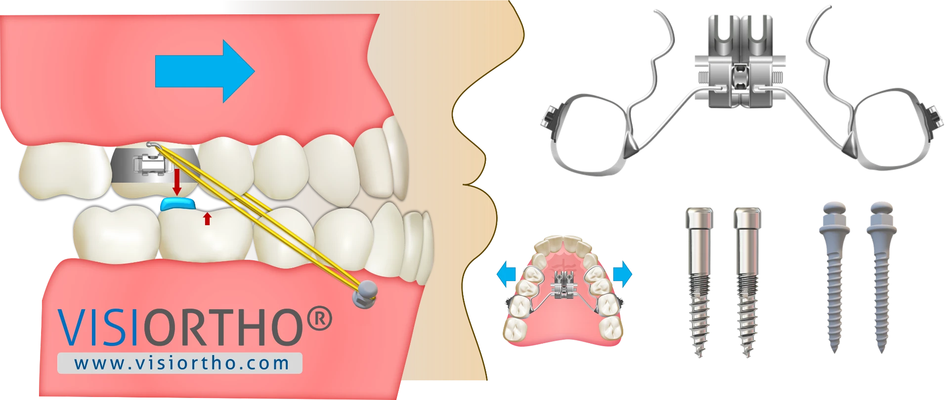Ilustração do Visiortho com os componentes do protocolo MAMP: expansor híbrido, mini-implantes e elásticos de Classe III.