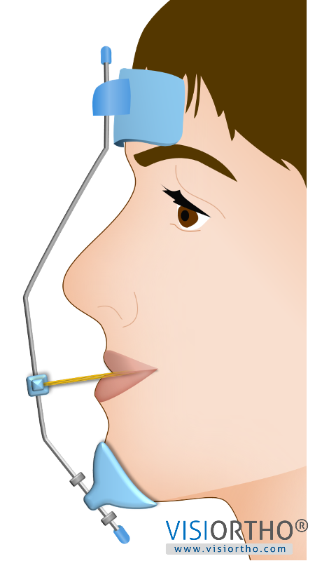 Criança de 8 anos com máscara facial.