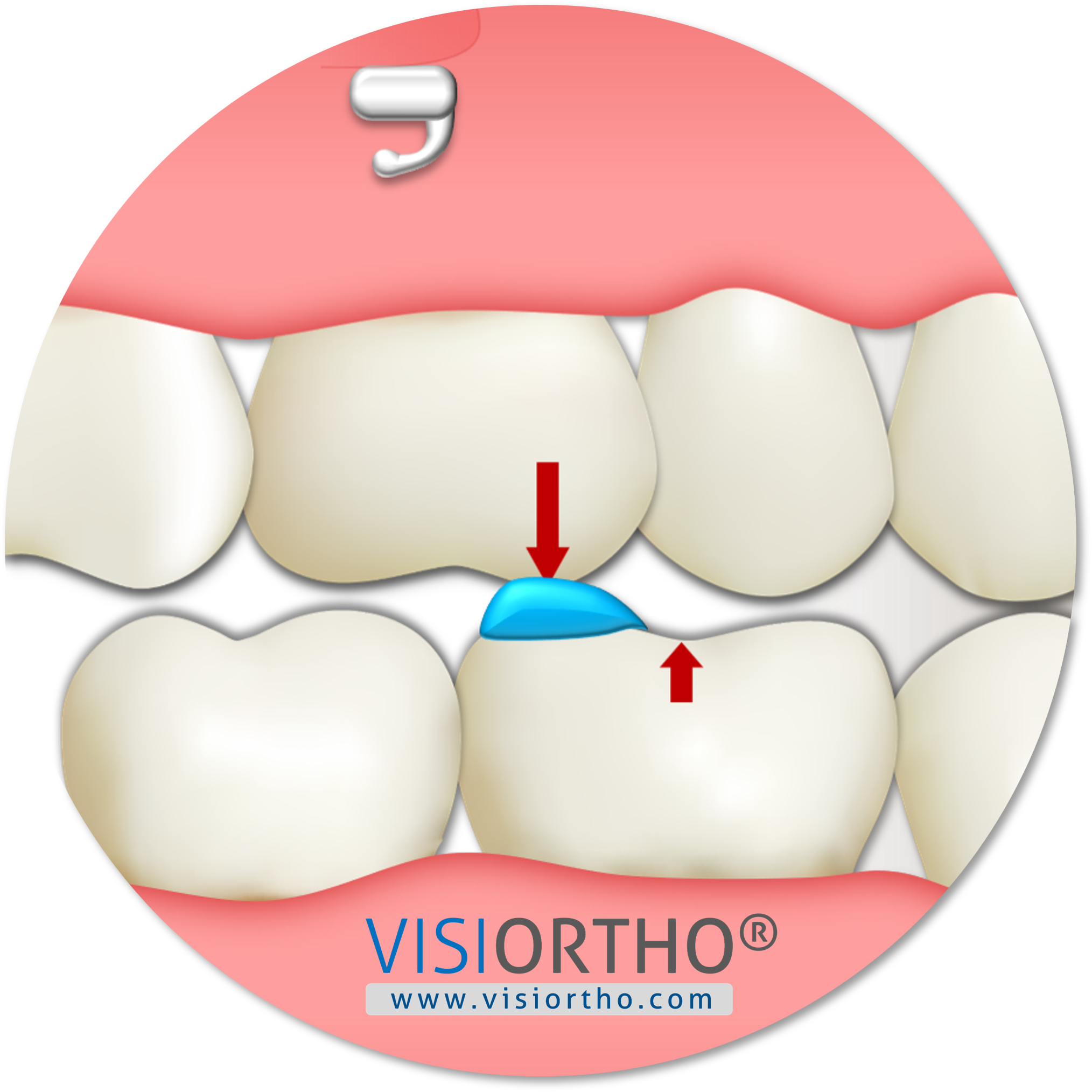 Levante de mordida posterior com resina.