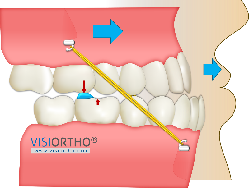 Animação do Visiortho do Protocolo BAMP tracionando a maxila.