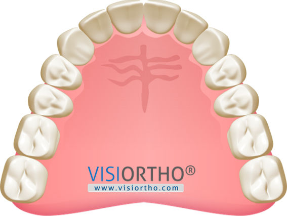 Arcada superior com os dentes anteriores alinhados após o tratamento.